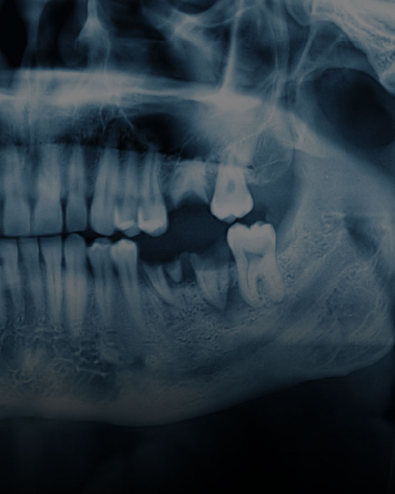 Dental x-ray showing missing teeth